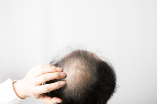 ウエストのおんな、ハゲ